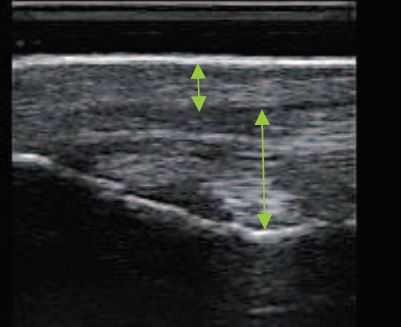 Echographie face interne du genou gauche cheval après cryothérapie